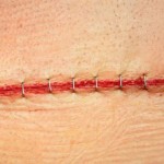 Stapled Wound