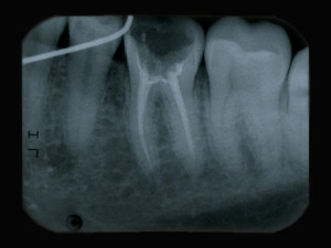 Tooth X-Ray